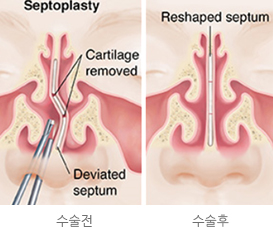 비중격 수술