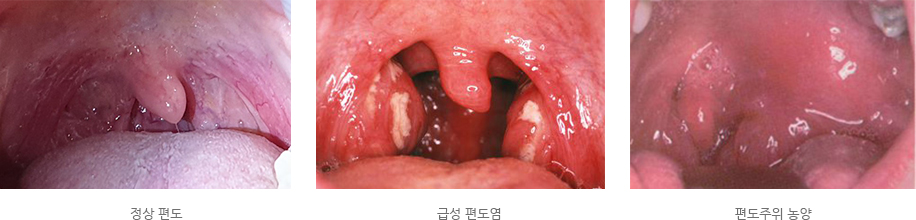 편도염